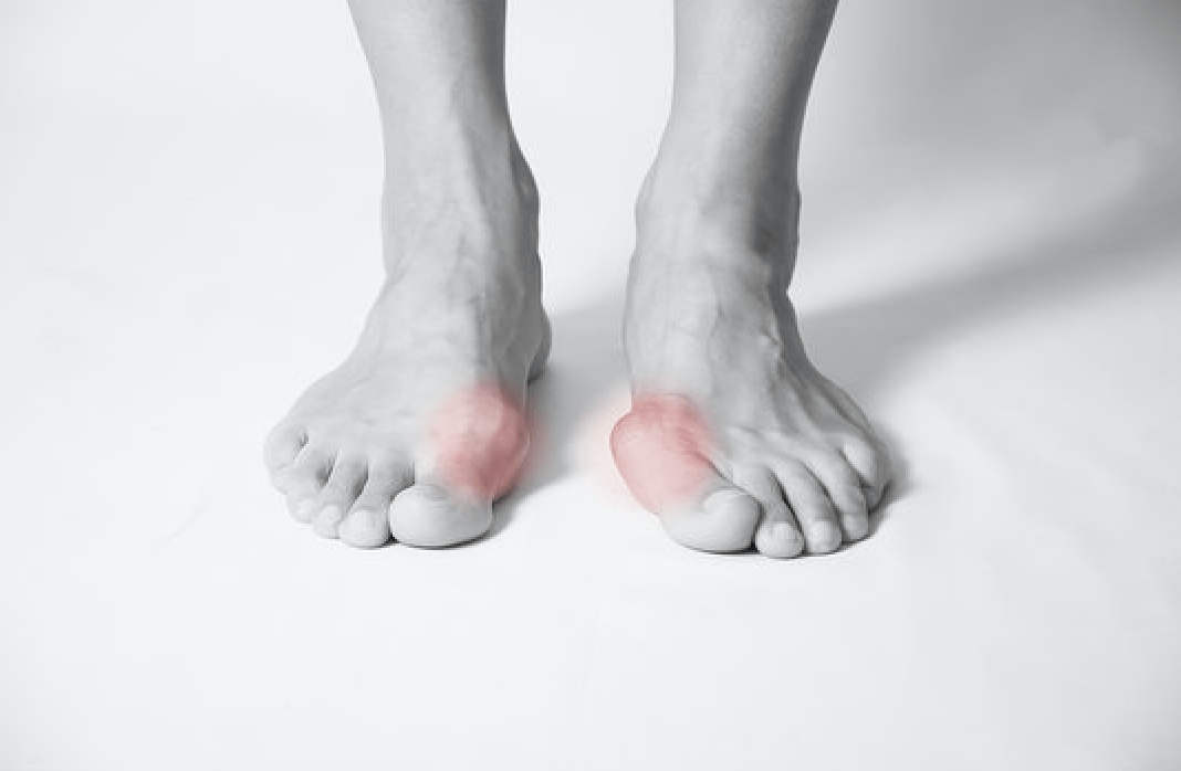 Dr Kevin Driscoll Bunion-Pain Bunions  